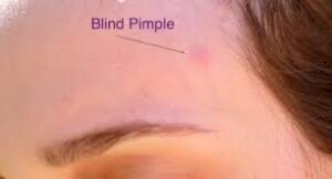 blind pimple